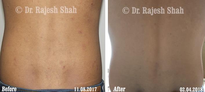 Lichen Planus Before and After Case Photo
