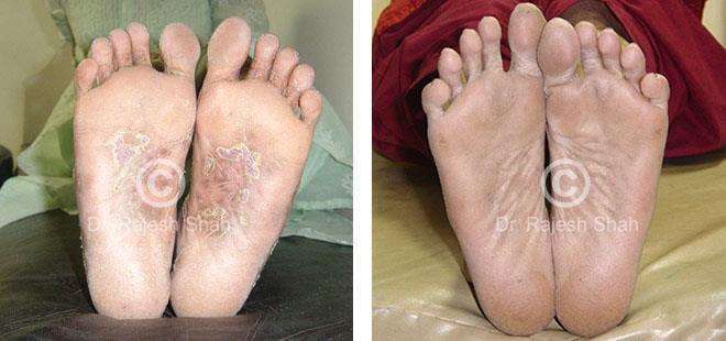 Lichen Planus Before and After Case Photo