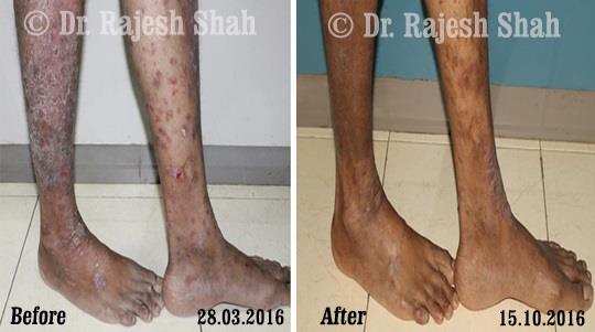 Psoriasis Before and After Case Photo