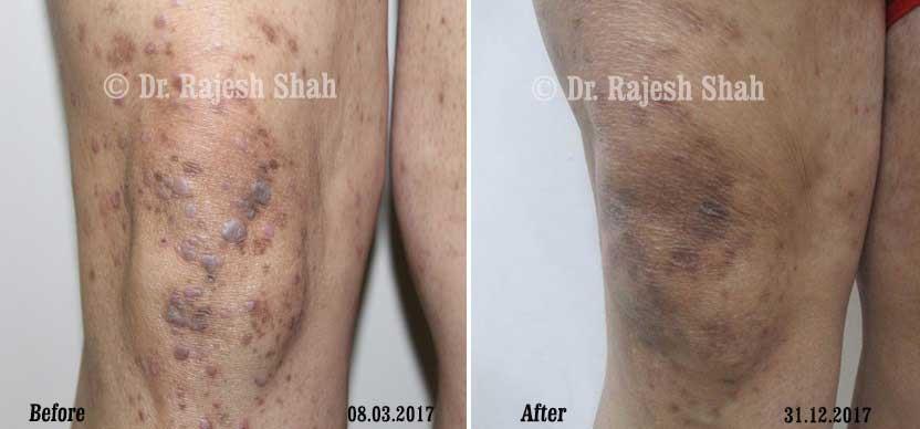 Lichen Planus Before and After Case Photo