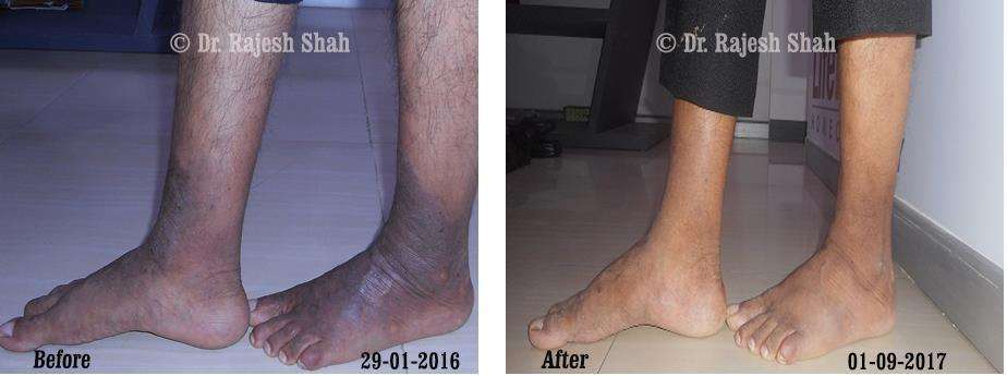 Eczema Before and After Case Photo