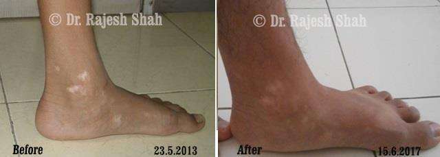 Vitiligo Before and After Case Photo