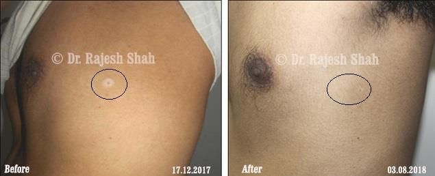 Vitiligo Before and After Case Photo