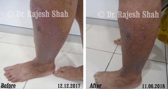 Psoriasis Before and After Case Photo