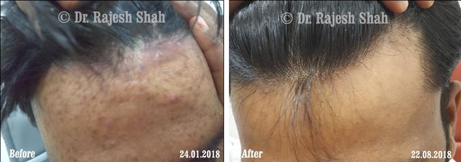 Psoriasis Before and After Case Photo