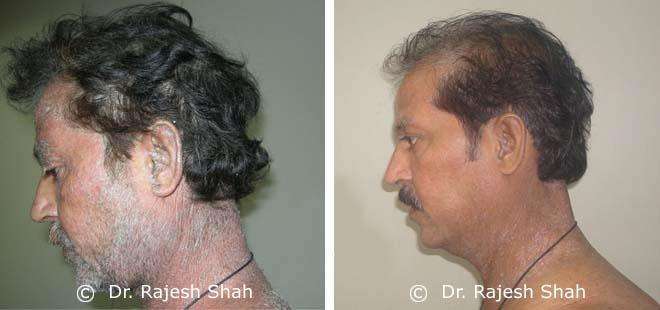 Psoriasis Before and After Case Photo