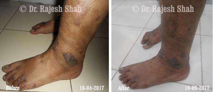 Atopic Dermatitis Before and After Case Photo