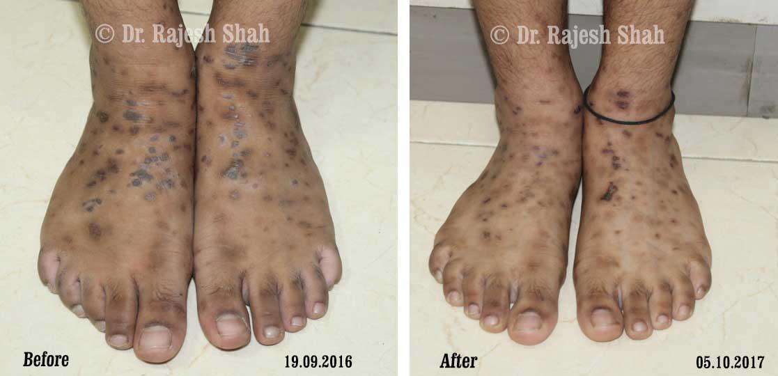 Lichen Planus Before and After Case Photo