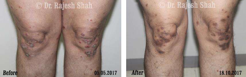 Psoriasis Before and After Case Photo