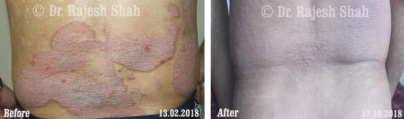 Psoriasis Before and After Case Photo
