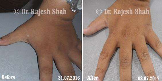 Vitiligo Before and After Case Photo