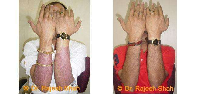 Psoriasis Before and After Case Photo