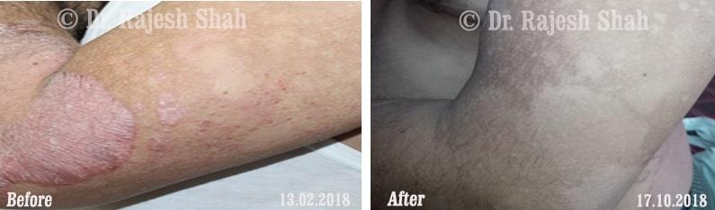 Psoriasis Before and After Case Photo