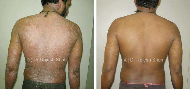 Psoriasis Before and After Case Photo