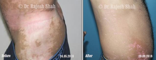 Vitiligo Before and After Case Photo