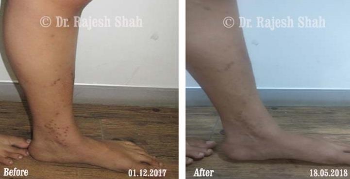 Lichen Planus Before and After Case Photo