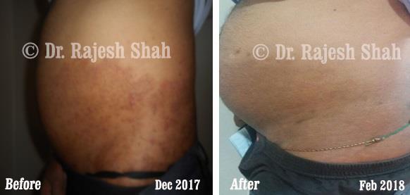 Tinea Corporis Before and After Case Photo