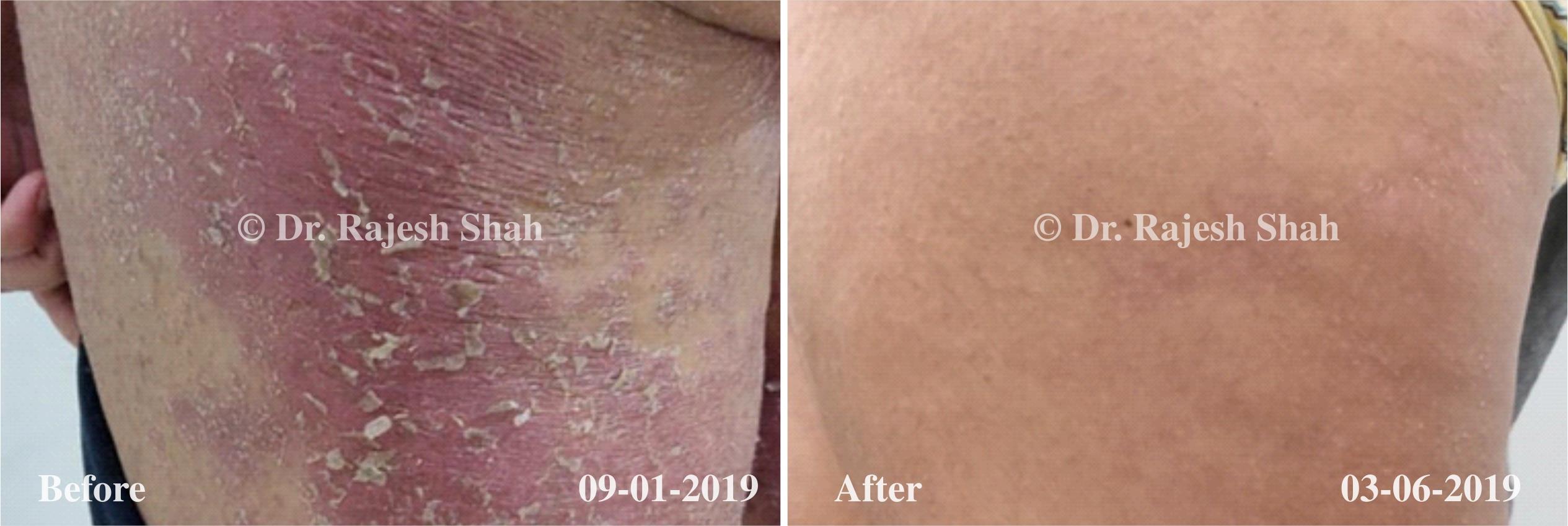Psoriasis Before and After Case Photo