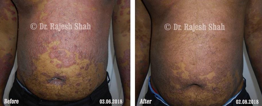 Psoriasis Before and After Case Photo