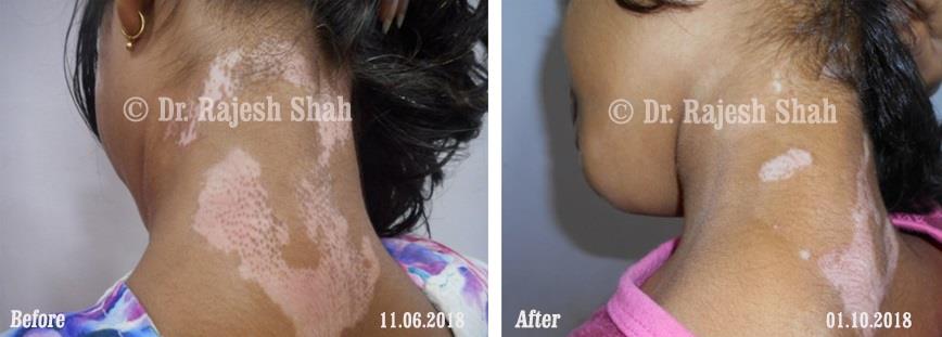 Vitiligo Before and After Case Photo