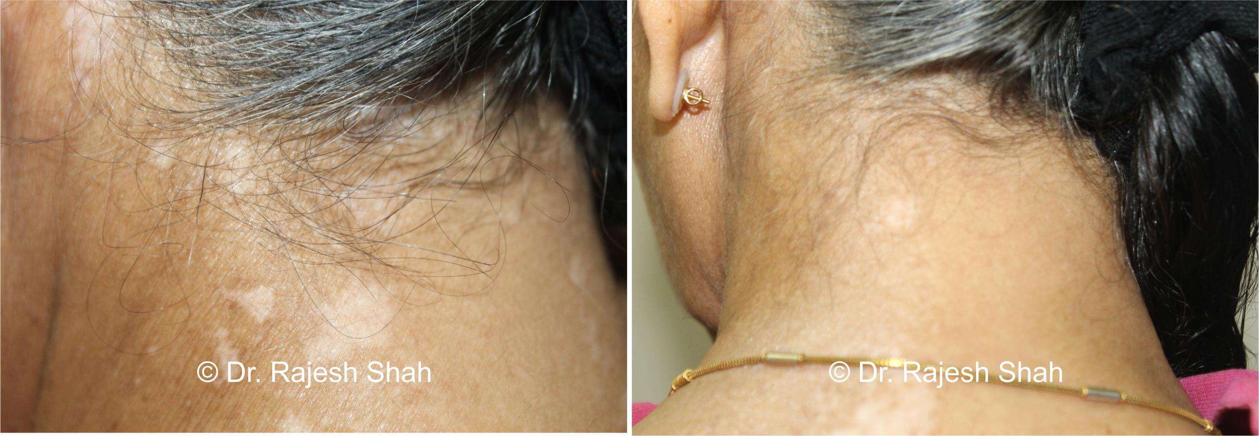 Vitiligo Before and After Case Photo