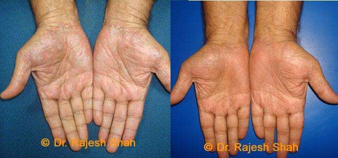 Psoriasis Before and After Case Photo