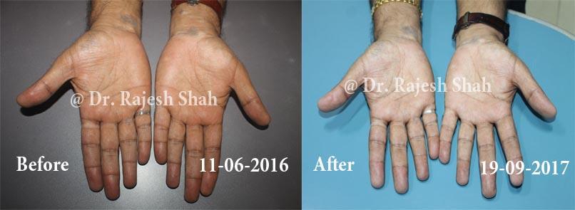 Vitiligo Before and After Case Photo