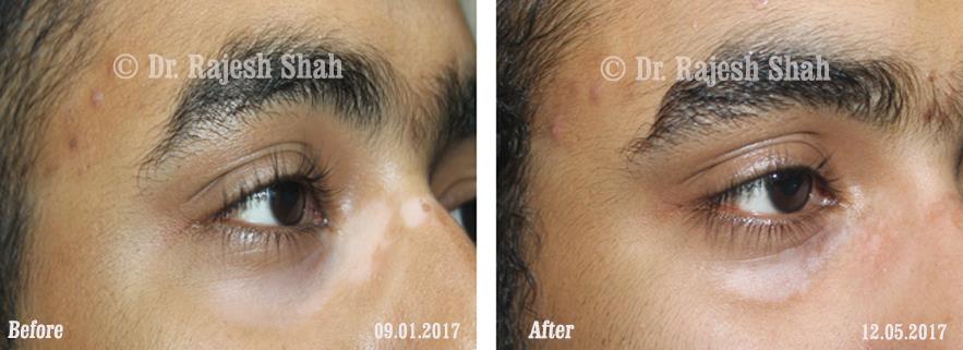 Vitiligo Before and After Case Photo