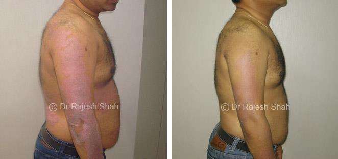 Psoriasis Before and After Case Photo
