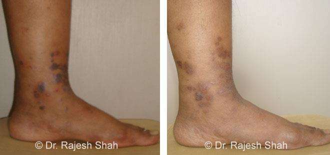 Lichen Planus Before and After Case Photo