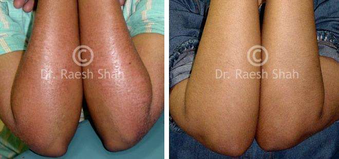 Eczema Before and After Case Photo