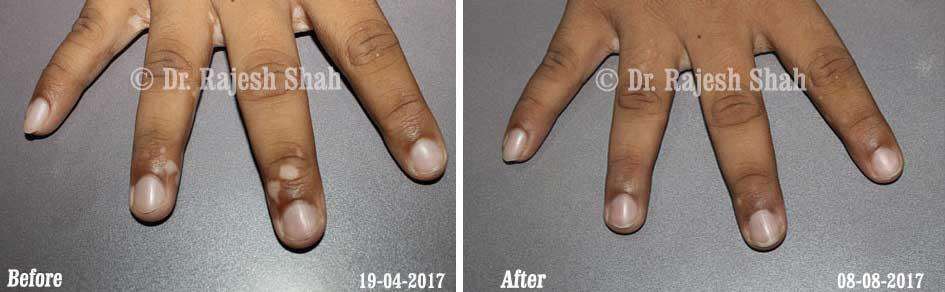 Vitiligo Before and After Case Photo