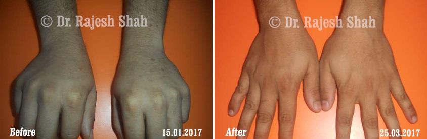 Psoriasis Before and After Case Photo