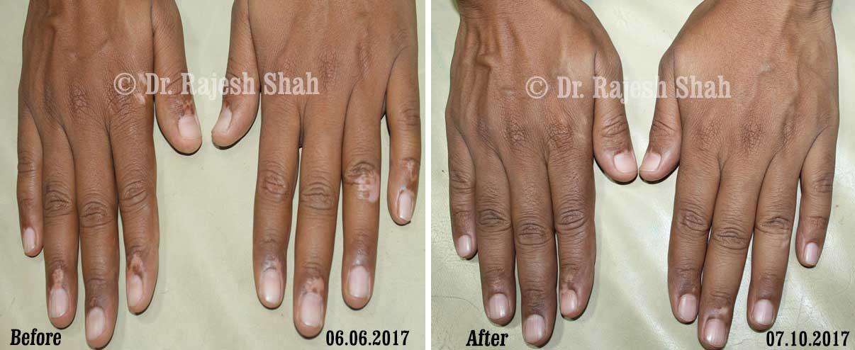 Vitiligo Before and After Case Photo