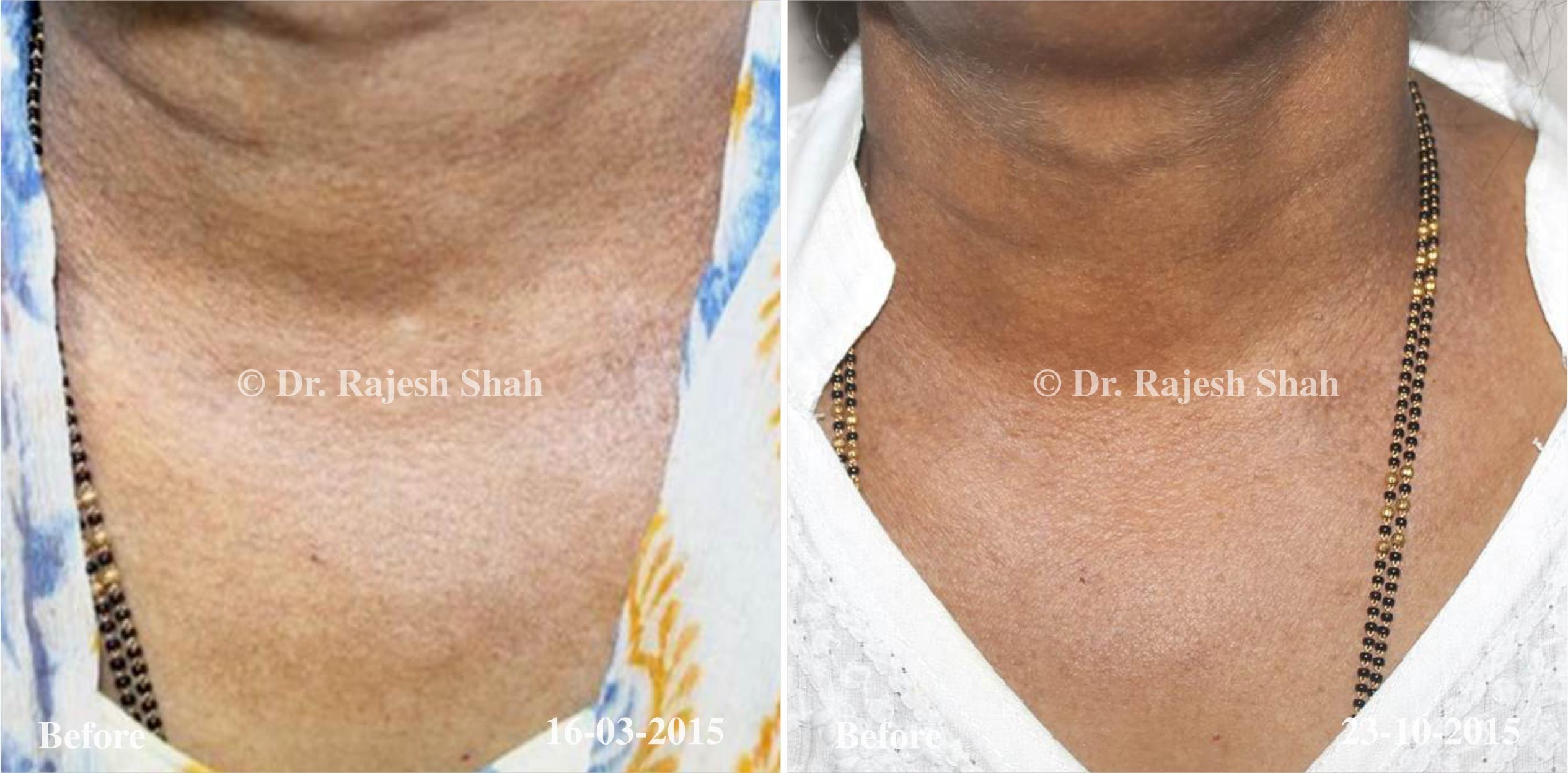 Vitiligo Before and After Case Photo