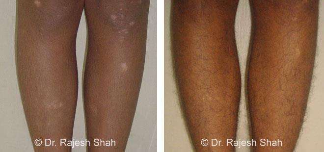 Before and After Case Photo