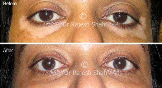 Vitiligo Before and After Case Photo