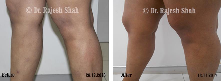 Lichen Planus Before and After Case Photo