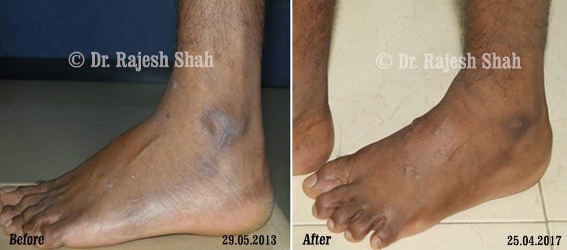 Lichen Planus Before and After Case Photo