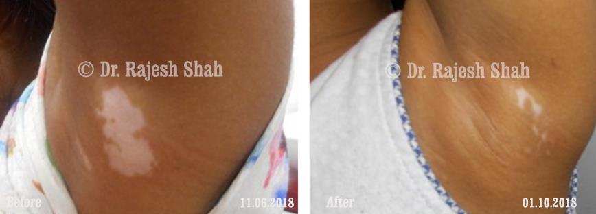 Vitiligo Before and After Case Photo