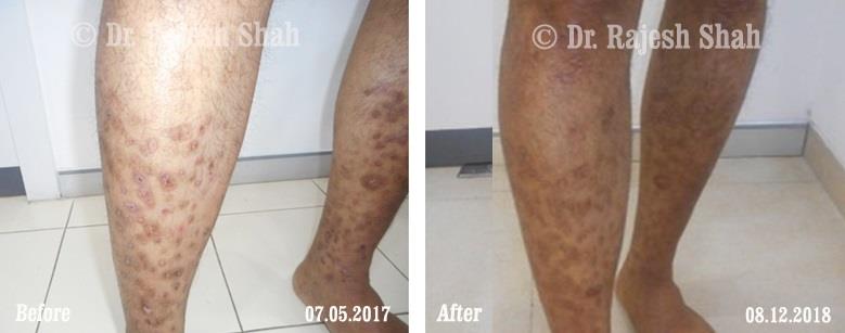 Lichen Planus Before and After Case Photo