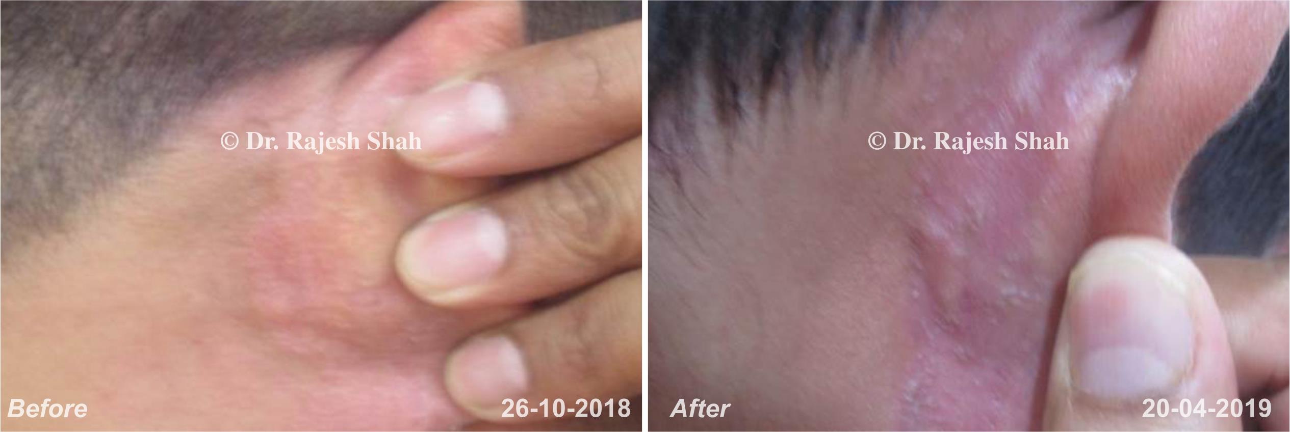 Psoriasis Before and After Case Photo