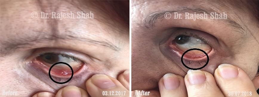 Chalazion Before and After Case Photo