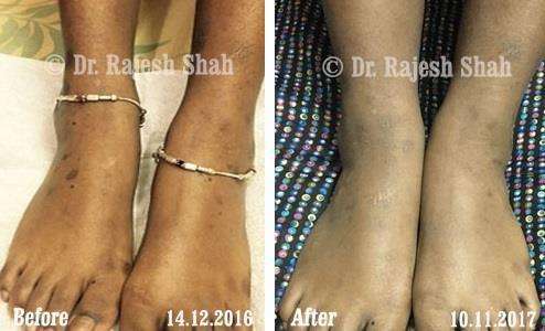 Lichen Planus Before and After Case Photo