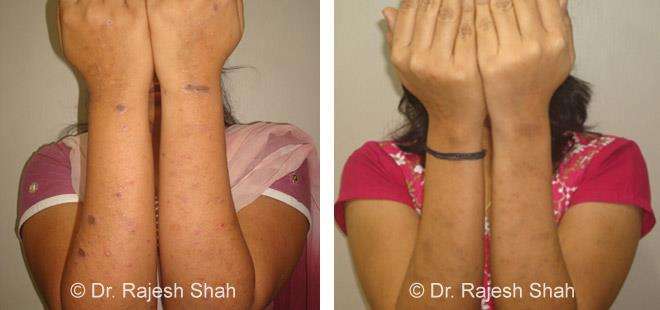 Lichen Planus Before and After Case Photo