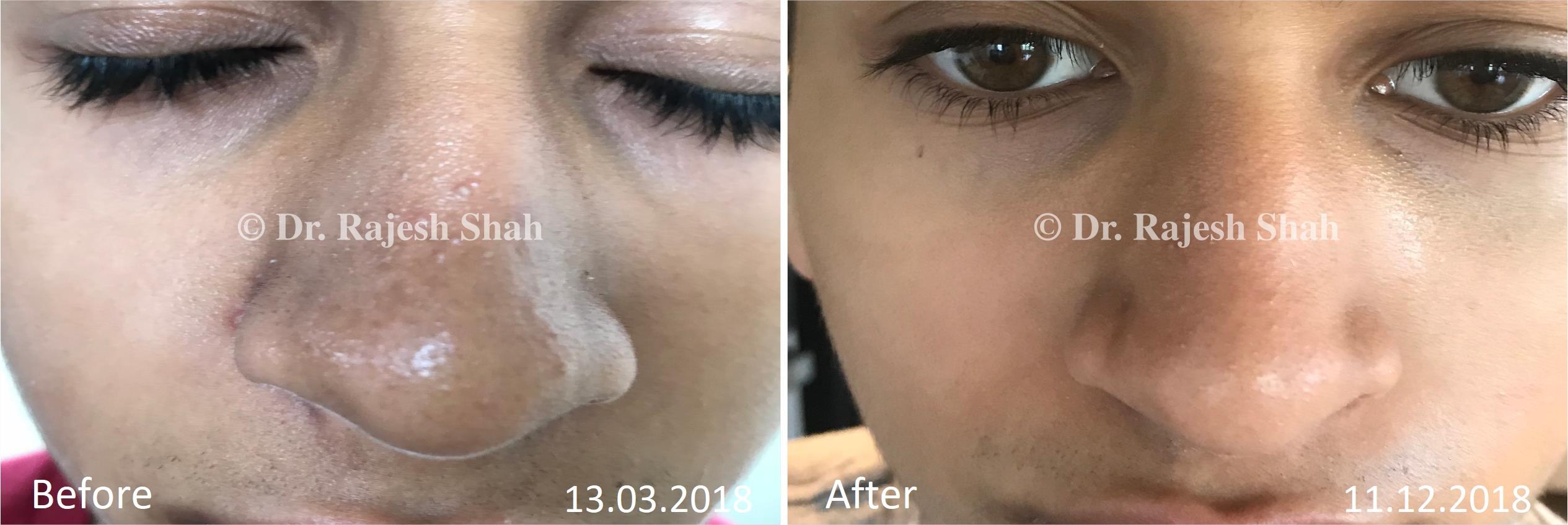 Seborrhoeic Dermatitis