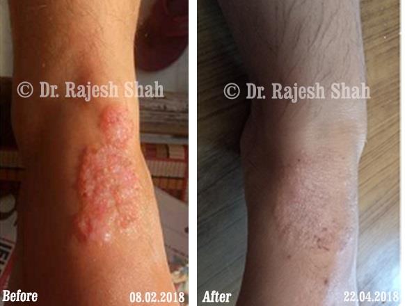 Eczema Before and After Case Photo