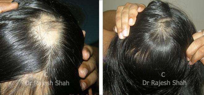 Alopecia Areata Before and After Case Photo
