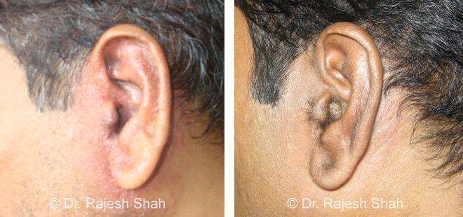 Psoriasis Before and After Case Photo