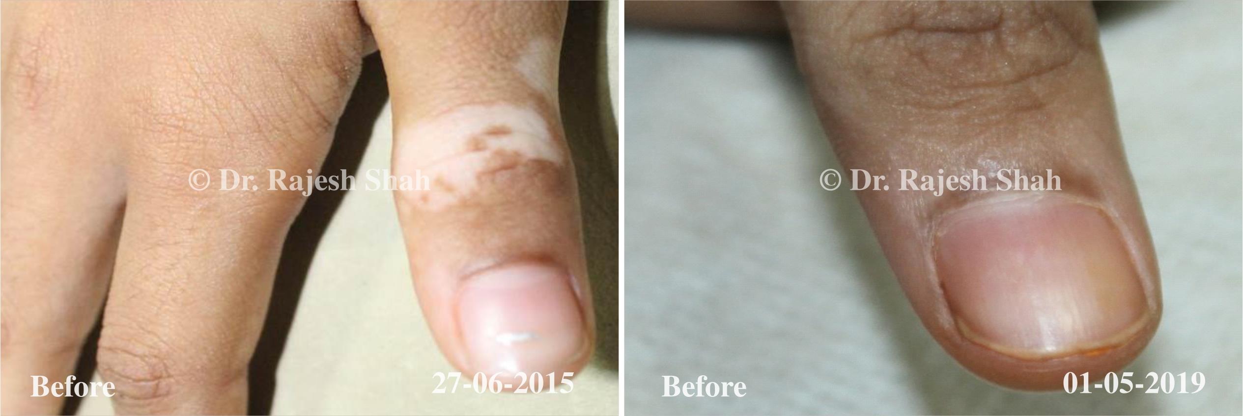 Vitiligo Before and After Case Photo